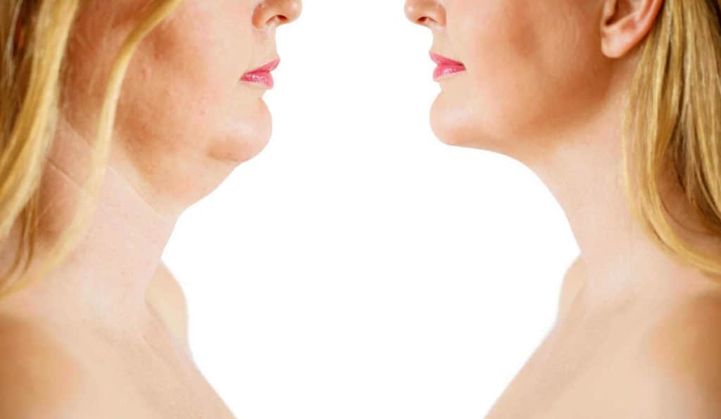 Double Chin treatment Royal Leamington Spa before and after results