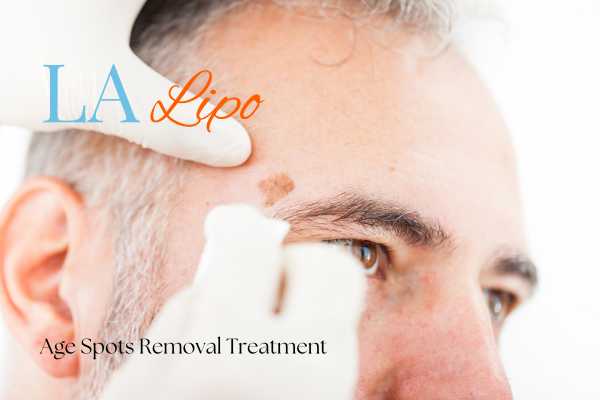 What Are the Most Effective Treatments for Age Spots Royal Leamington Spa?