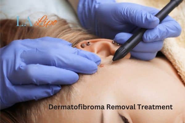 Dermatofibroma Removal Treatment Royal Leamington Spa