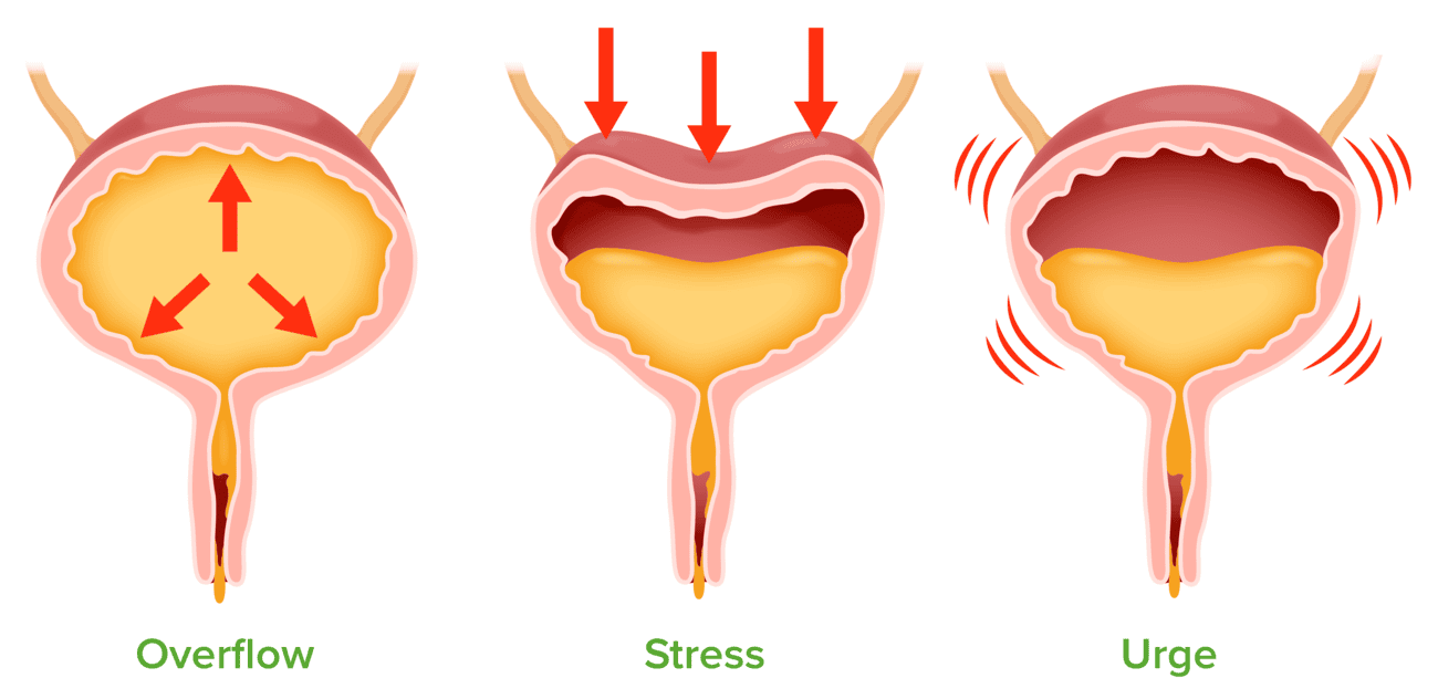 Understanding More Urine Incontinence Royal Leamington Spa