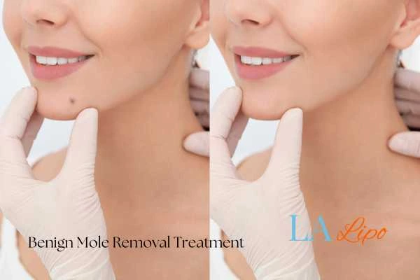 Before-and-after results following benign mole-removal treatment Royal Leamington Spa