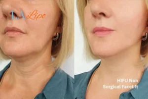 hi-fu for wrinkles Royal Leamington Spa before and after results