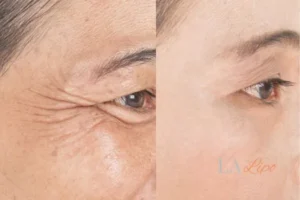 Before and after results of woman - HI-fu wrinkles reduction treatment Royal Leamington Spa