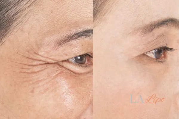 Before and after results of woman - HI-fu wrinkles reduction treatment Royal Leamington Spa