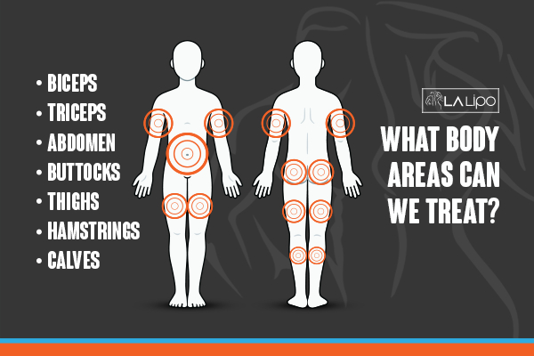 Graphic to show areas you can have LA-EMS Body Sculpting Royal Leamington Spa treatment.