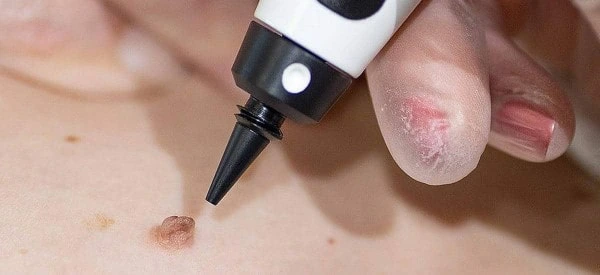 skin tag removal using cryopen Royal Leamington Spa