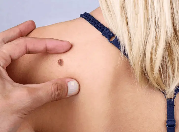 woman having mole removal Royal Leamington Spa consultation before treatment.