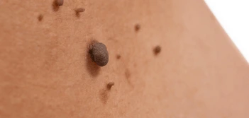 image of a skin tag Royal Leamington Spa