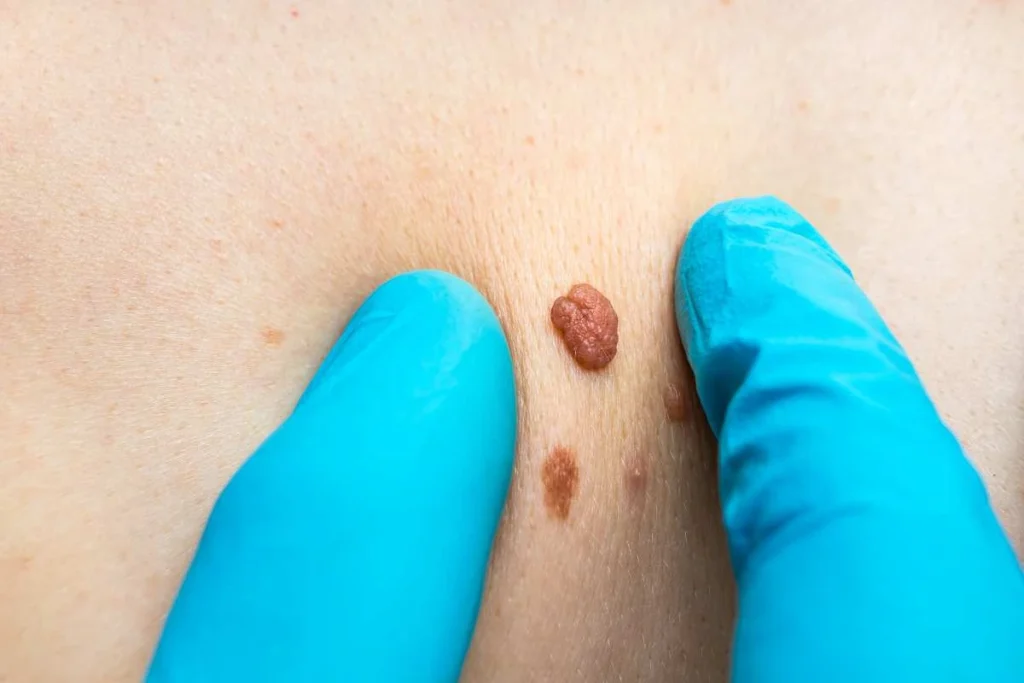 Consultant examining a skin tag Royal Leamington Spa
