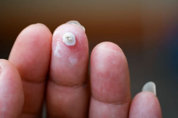 wart on person finger - cryotherapy to treat from LA LIPO Royal Leamington Spa