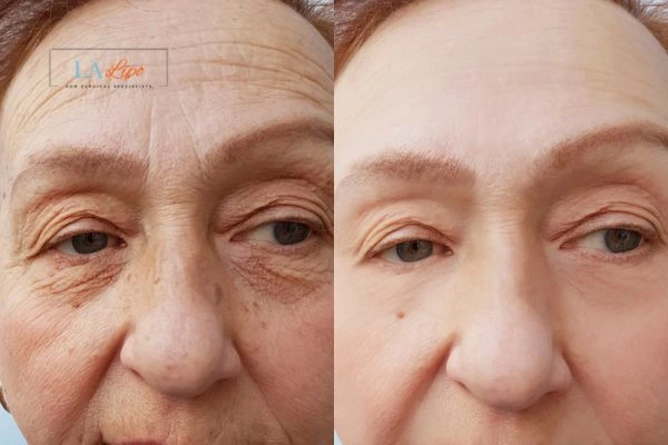The powerful benefits of Morpheus8 Treatment Royal Leamington Spa - Call Our team today!