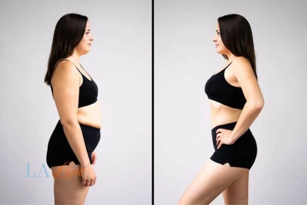 Picture of womans before and after using LA-EMS body sculpting to improve her core strength Royal Leamington Spa