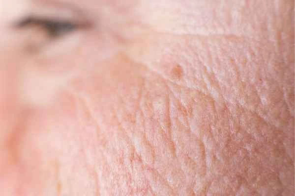 close up picture of a woman's face showing an age spot Royal Leamington Spa