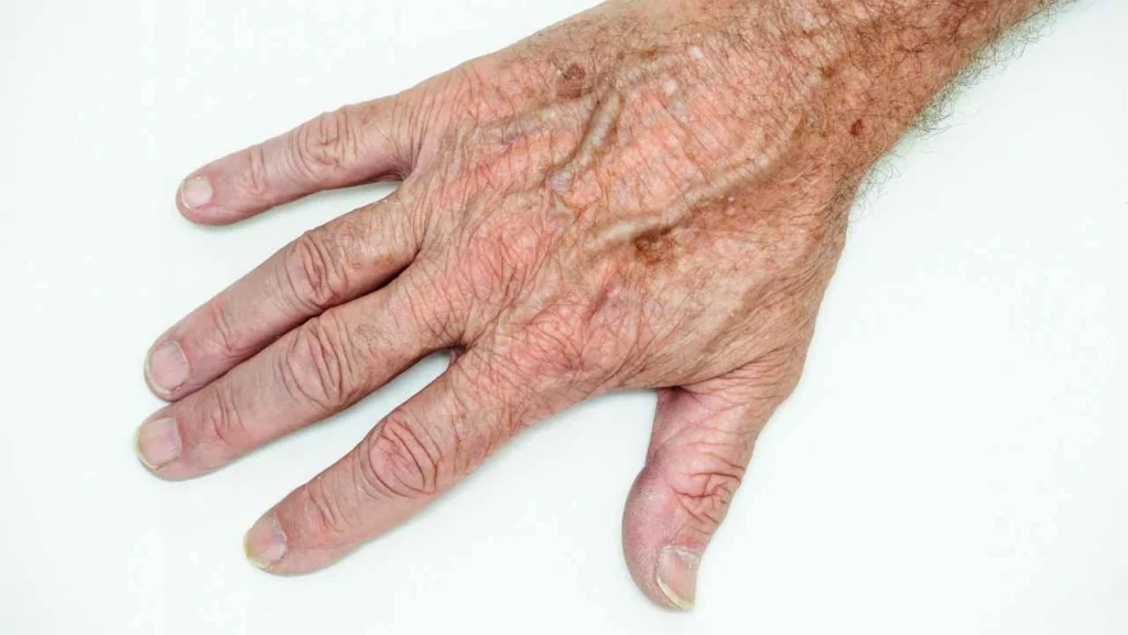 Male hand showing age spot Royal Leamington Spa