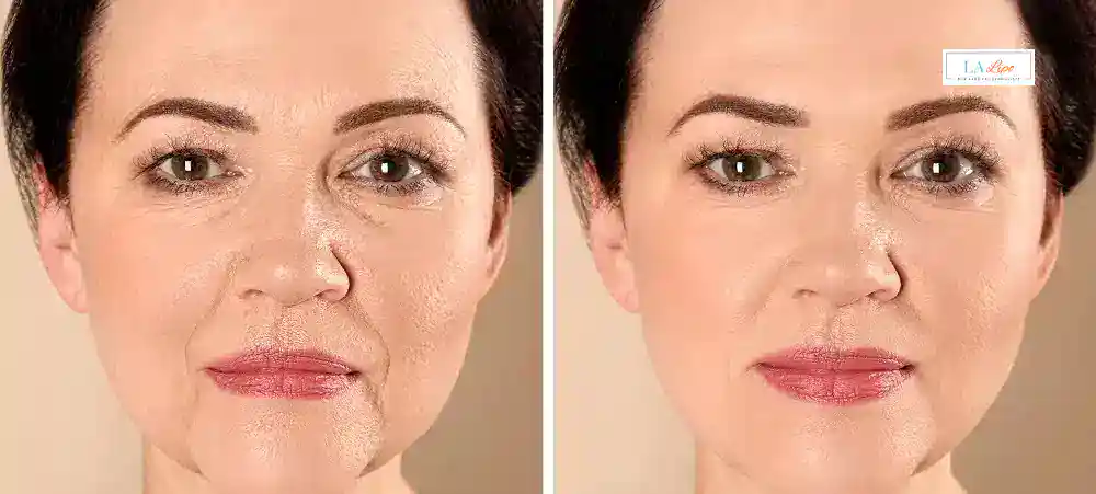 How Long Does It Take to See Results and How Long Do They Last Royal Leamington Spa?