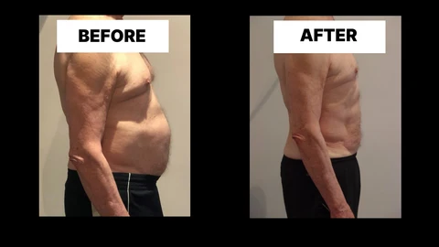 What Symptoms Can Diastasis Recti Cause in Men? Weak Core, Back Pain and Poor Posture Royal Leamington Spa